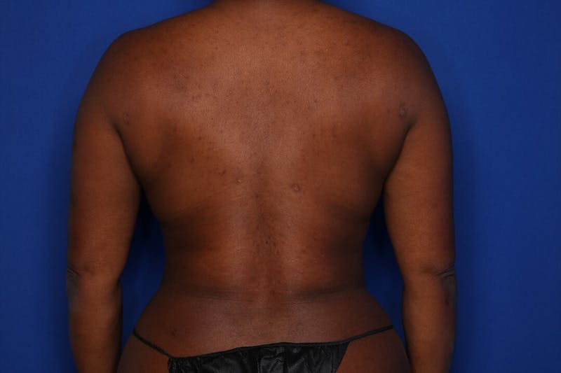 BodyTite™ Before and After Before & After Gallery - Patient 109695 - Image 4