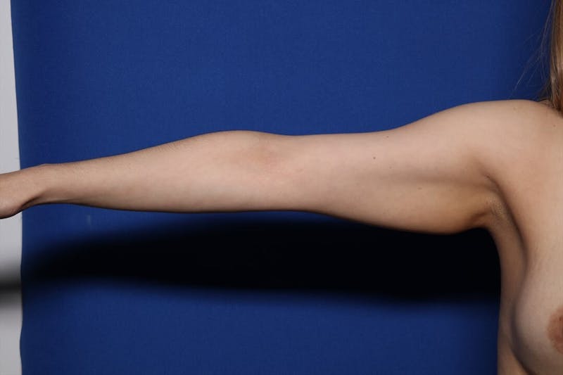 BodyTite™ Before and After Before & After Gallery - Patient 385689 - Image 7