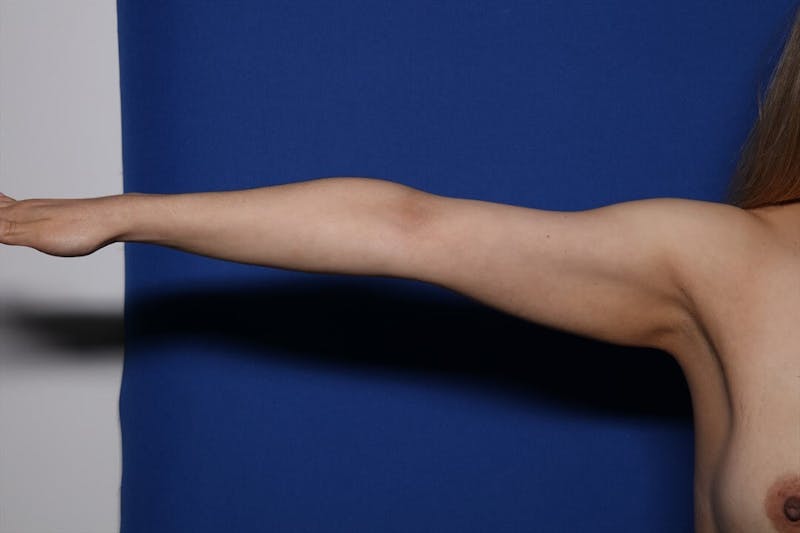 BodyTite™ Before and After Before & After Gallery - Patient 385689 - Image 8