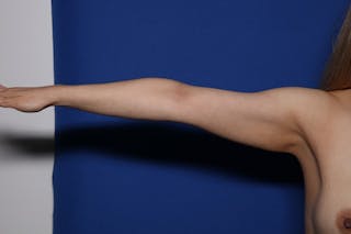 BodyTite™ Before and After Before & After Gallery - Patient 385689 - Image 8