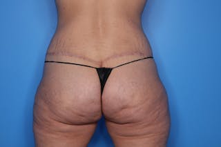 Body Lift Before & After Gallery - Patient 128454 - Image 4