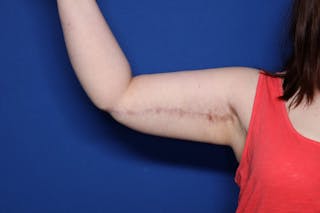 Arm Lift Before & After Gallery - Patient 398392 - Image 2