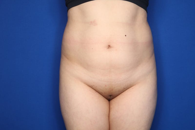 Brazilian Butt Lift Before & After Gallery - Patient 389407 - Image 7