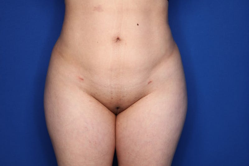 Brazilian Butt Lift Before & After Gallery - Patient 389407 - Image 8