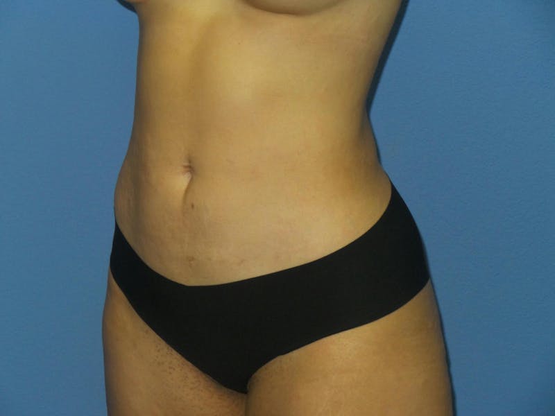 BodyTite™ Before and After Before & After Gallery - Patient 146425 - Image 6