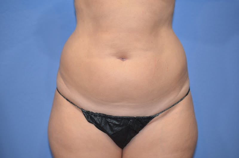 BodyTite™ Before and After Before & After Gallery - Patient 406925 - Image 1