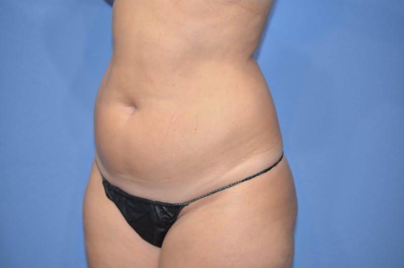 BodyTite™ Before and After Before & After Gallery - Patient 406925 - Image 3