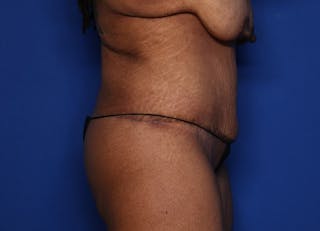 Body Lift Before & After Gallery - Patient 146807 - Image 4