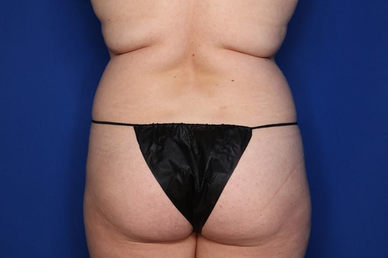 BodyTite™ Before and After Before & After Gallery - Patient 397454 - Image 3