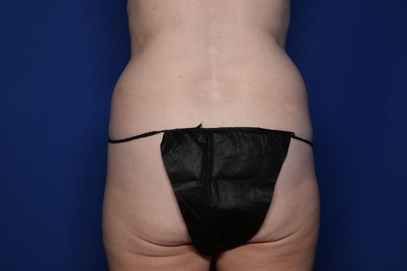 BodyTite™ Before and After Before & After Gallery - Patient 307858 - Image 3