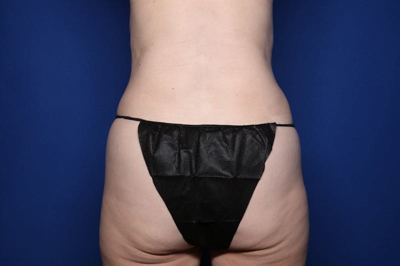 BodyTite™ Before and After Before & After Gallery - Patient 307858 - Image 4