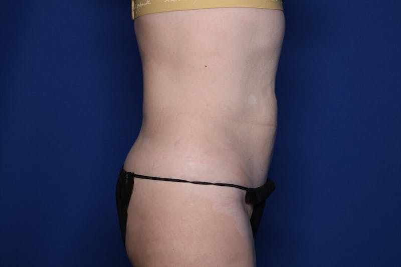 BodyTite™ Before and After Before & After Gallery - Patient 307858 - Image 6