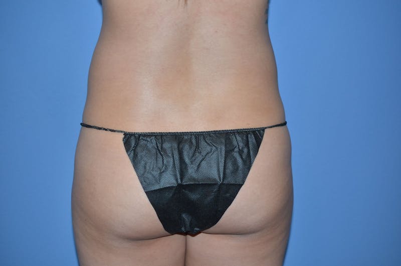BodyTite™ Before and After Before & After Gallery - Patient 270085 - Image 1