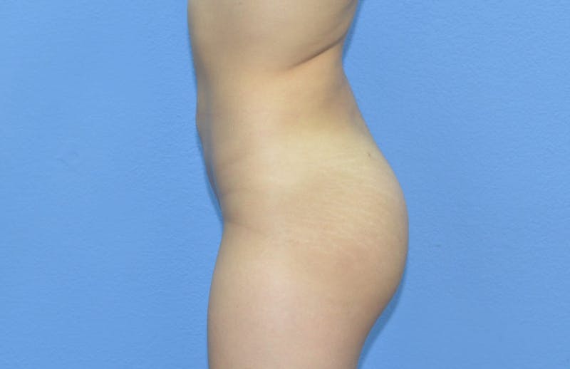 Brazilian Butt Lift Before & After Gallery - Patient 346644 - Image 2