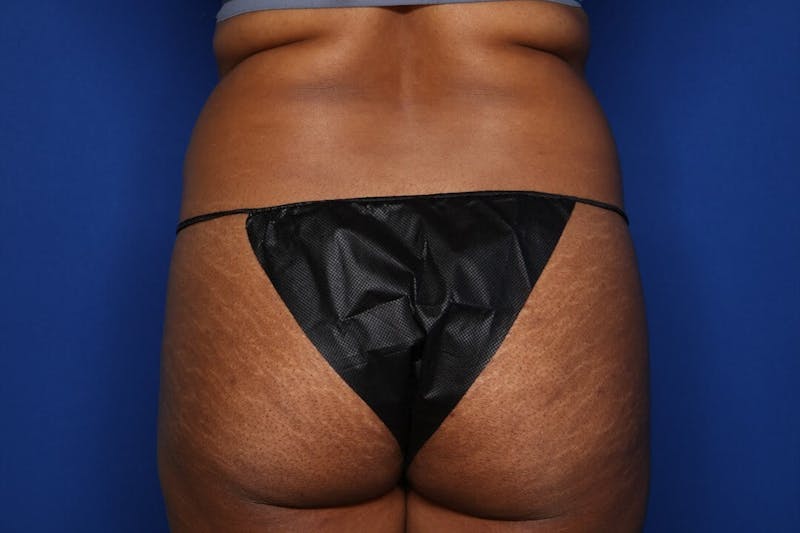 BodyTite™ Before and After Before & After Gallery - Patient 190890 - Image 5