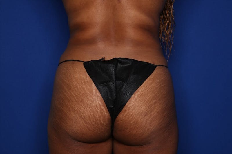 BodyTite™ Before and After Before & After Gallery - Patient 190890 - Image 6