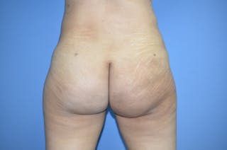 Brazilian Butt Lift Before & After Gallery - Patient 330451 - Image 4