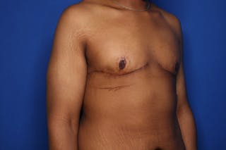 Gynecomastia (Male Breast Reduction) Before & After Gallery - Patient 207748 - Image 4