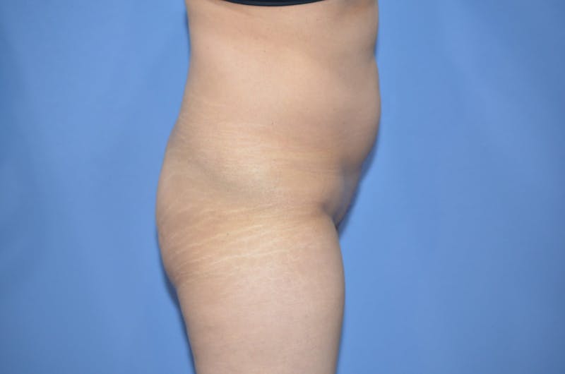 Brazilian Butt Lift Before & After Gallery - Patient 330451 - Image 1