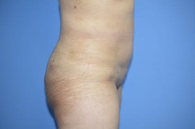 Brazilian Butt Lift Before & After Gallery - Patient 330451 - Image 2