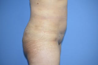 Brazilian Butt Lift Before & After Gallery - Patient 330451 - Image 2