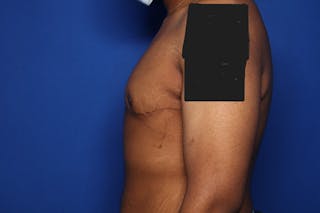 Gynecomastia (Male Breast Reduction) Before & After Gallery - Patient 207748 - Image 6
