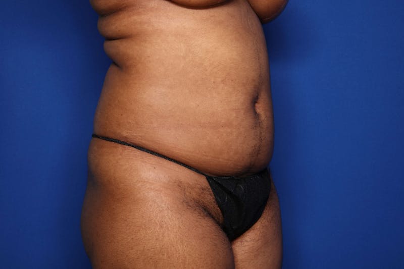 BodyTite™ Before and After Before & After Gallery - Patient 356888 - Image 1