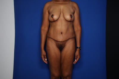 Mommy Makeover Before & After Gallery - Patient 639353 - Image 2