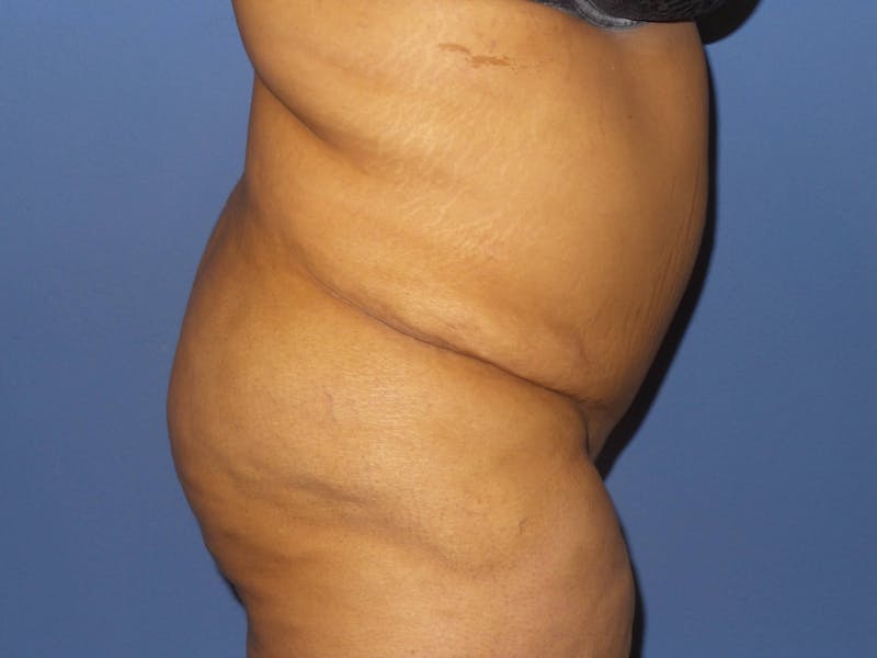 Brazilian Butt Lift Before & After Gallery - Patient 666456 - Image 1