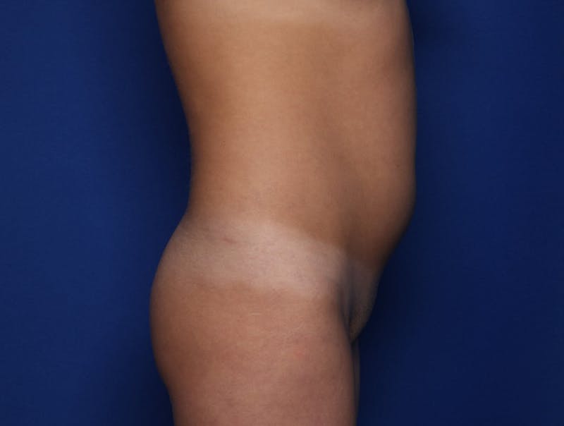 Liposuction Before & After Gallery - Patient 689767 - Image 3