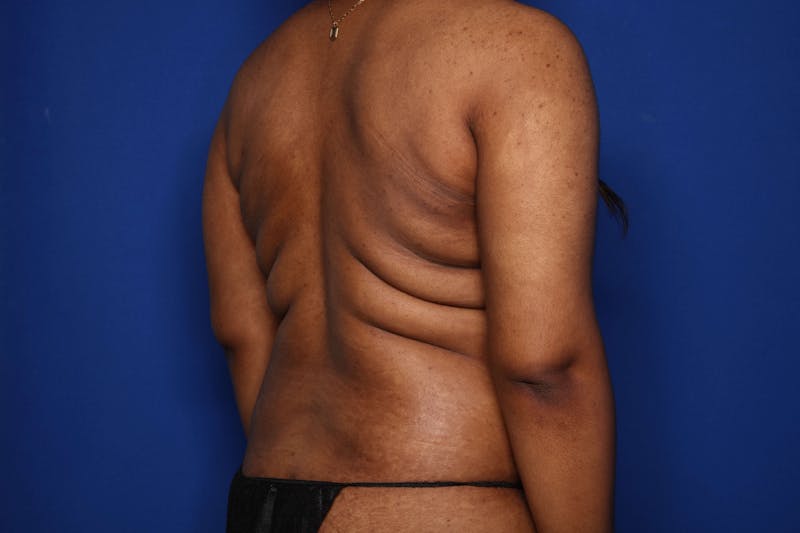 BodyTite™ Before and After Before & After Gallery - Patient 356888 - Image 3