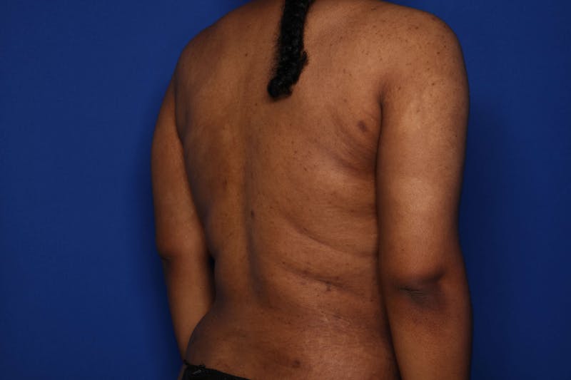 BodyTite™ Before and After Before & After Gallery - Patient 356888 - Image 4