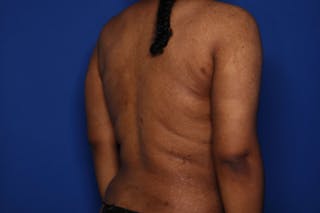 BodyTite™ Before and After Before & After Gallery - Patient 356888 - Image 4