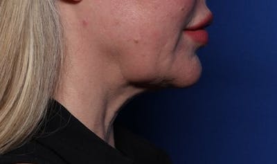 FaceTite Before and After Before & After Gallery - Patient 144838 - Image 2