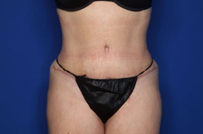 Tummy Tuck Before & After Gallery - Patient 707789 - Image 2