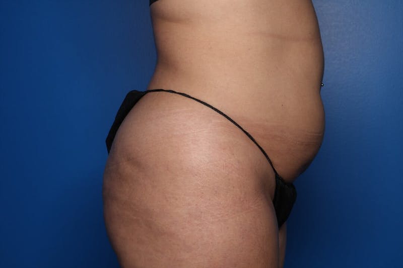 BodyTite™ Before and After Before & After Gallery - Patient 367953 - Image 3