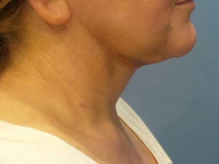 FaceTite Before and After Before & After Gallery - Patient 134935 - Image 2
