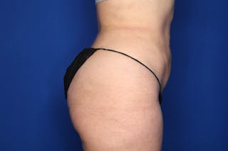 BodyTite™ Before and After Before & After Gallery - Patient 367953 - Image 4