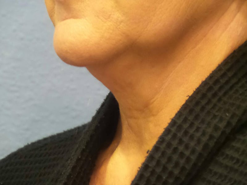 FaceTite Before and After Before & After Gallery - Patient 134935 - Image 3