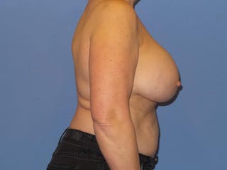 Breast Lift Before & After Gallery - Patient 866099 - Image 4