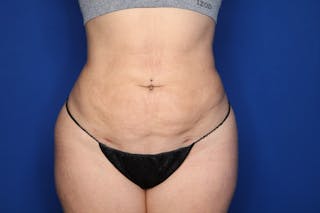 BodyTite™ Before and After Before & After Gallery - Patient 367953 - Image 6