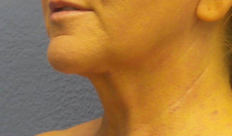 FaceTite Before and After Before & After Gallery - Patient 134935 - Image 4