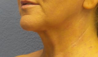 FaceTite Before and After Before & After Gallery - Patient 134935 - Image 4