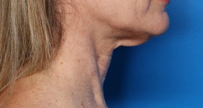 FaceTite Before and After Before & After Gallery - Patient 854461 - Image 1