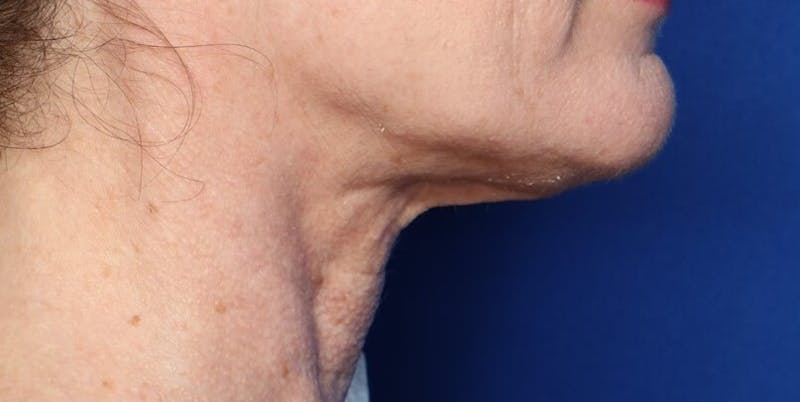 FaceTite Before and After Before & After Gallery - Patient 854461 - Image 2