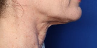 FaceTite Before and After Before & After Gallery - Patient 854461 - Image 2