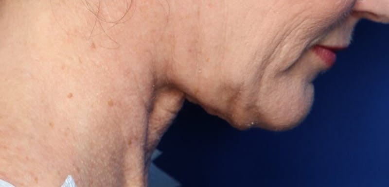 FaceTite Before and After Before & After Gallery - Patient 854461 - Image 4