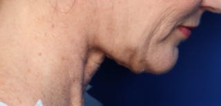 FaceTite Before and After Before & After Gallery - Patient 854461 - Image 4