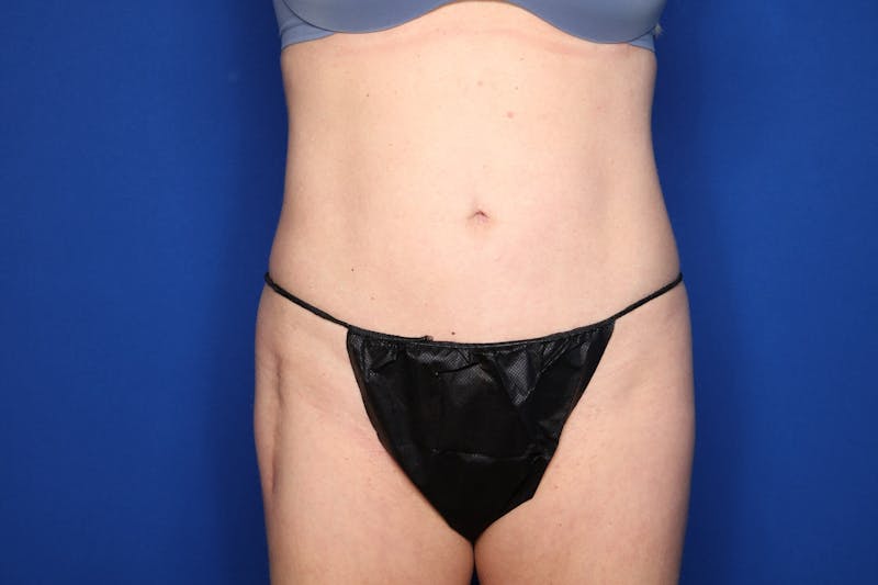 BodyTite™ Before and After Before & After Gallery - Patient 437377 - Image 4