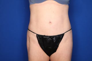 BodyTite™ Before and After Before & After Gallery - Patient 437377 - Image 4